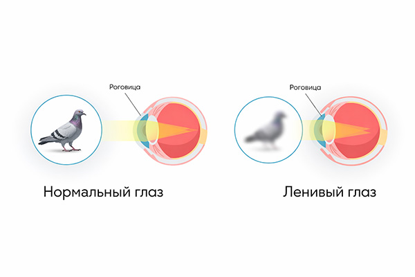 Причины ухудшения зрения одного глаза