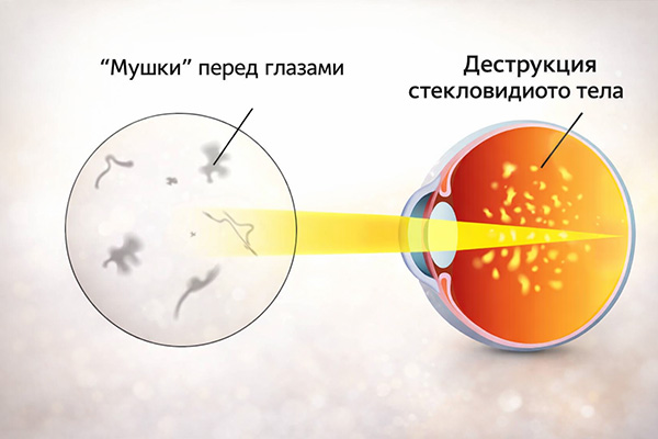 Причины деструкции