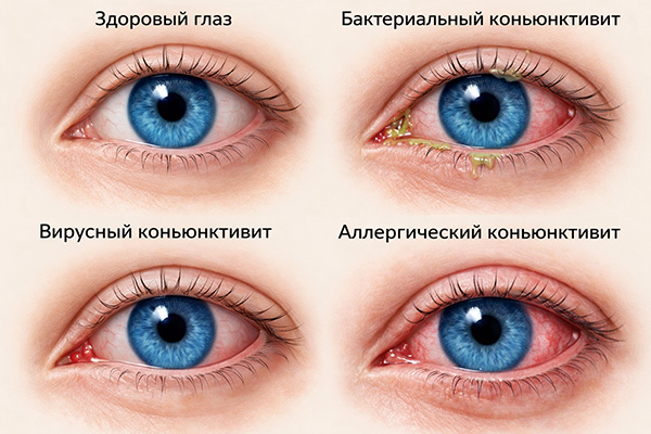 Виды гноения глаз