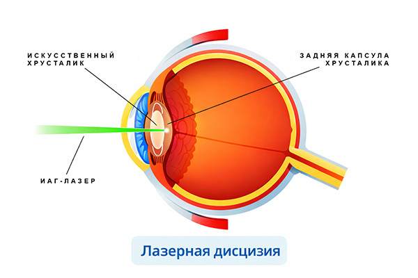 Лазерная капсулотомия, или лазерная дисцизия