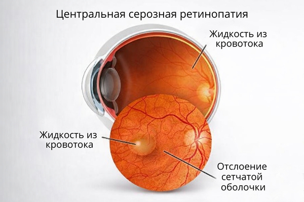 Причины хориоретинопатии